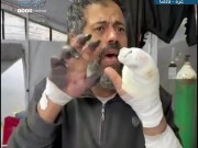 مصعب أبو طعيمة يفقد أطرافه تدريجيًا في ظل نقص العلاج